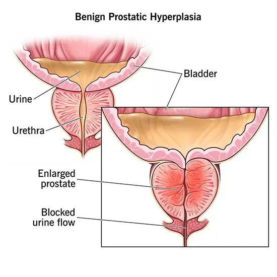 benign prostatic hyperplasia package test